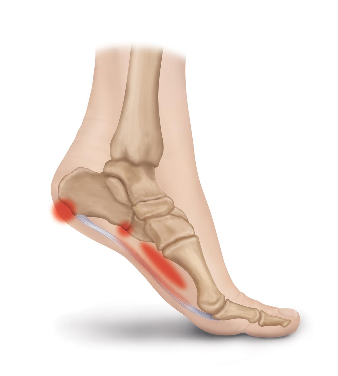 Plantar fasciitis causing foot pain – Burleigh Physio