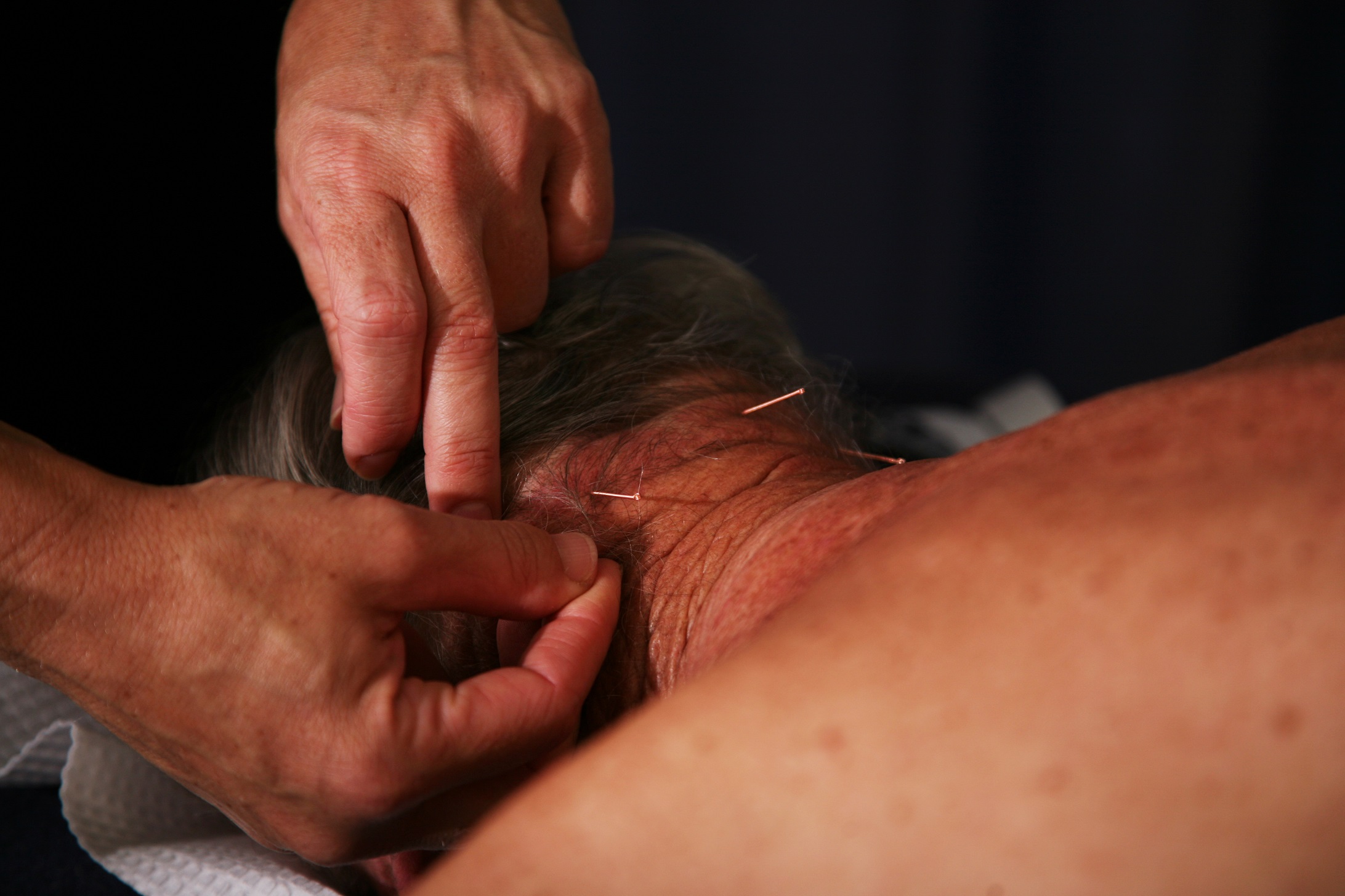 trigger point dry needling