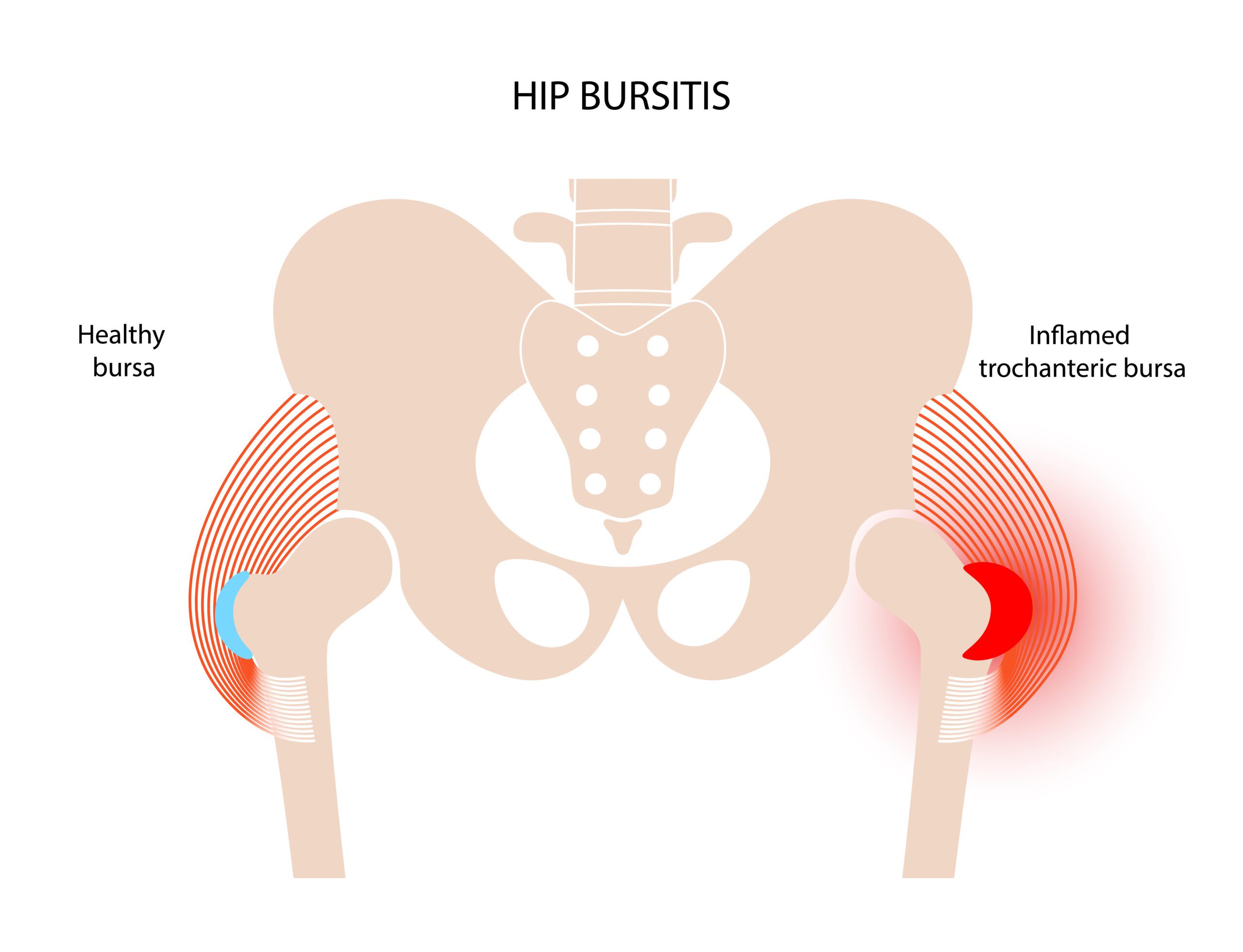 Hip (Trochanteric) Bursitis